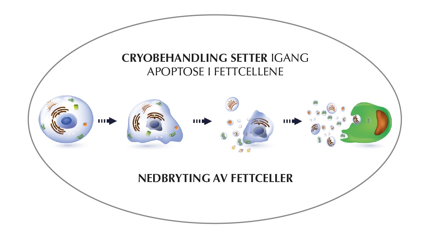 Illustrasjon: cryobehandling setter i gang apoptose og nedbryting av fettceller